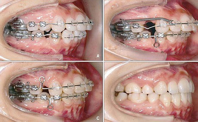 Niềng răng cho trường hợp người răng hô - Nhakhoadalat.vn
